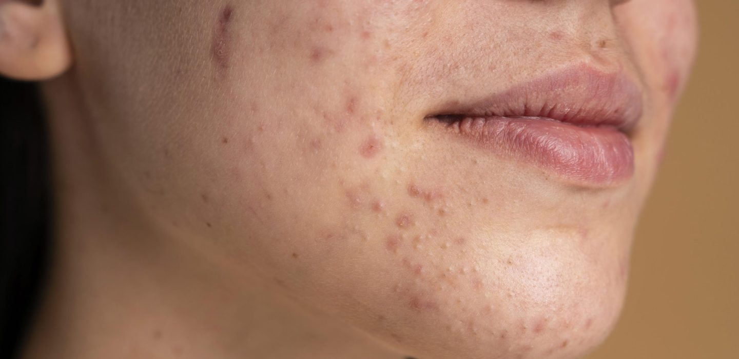 confident-young-woman-with-acne-close-up
